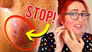 THIS Is Why You Should NEVER Squeeze Or POP A Pimple! (MY EXPERIENCE) Jess Bunty