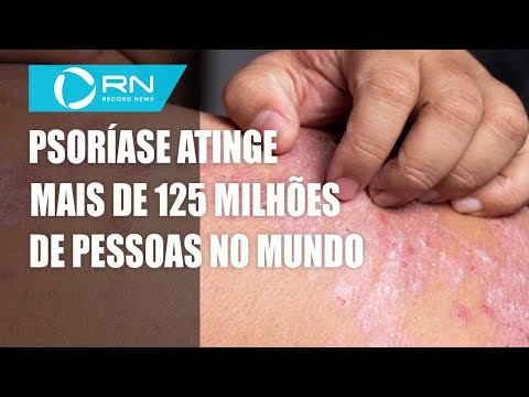 Psoríase atinge 5 milhões de brasileiros