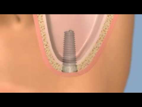 Sinus Lift / Sinus Elevation