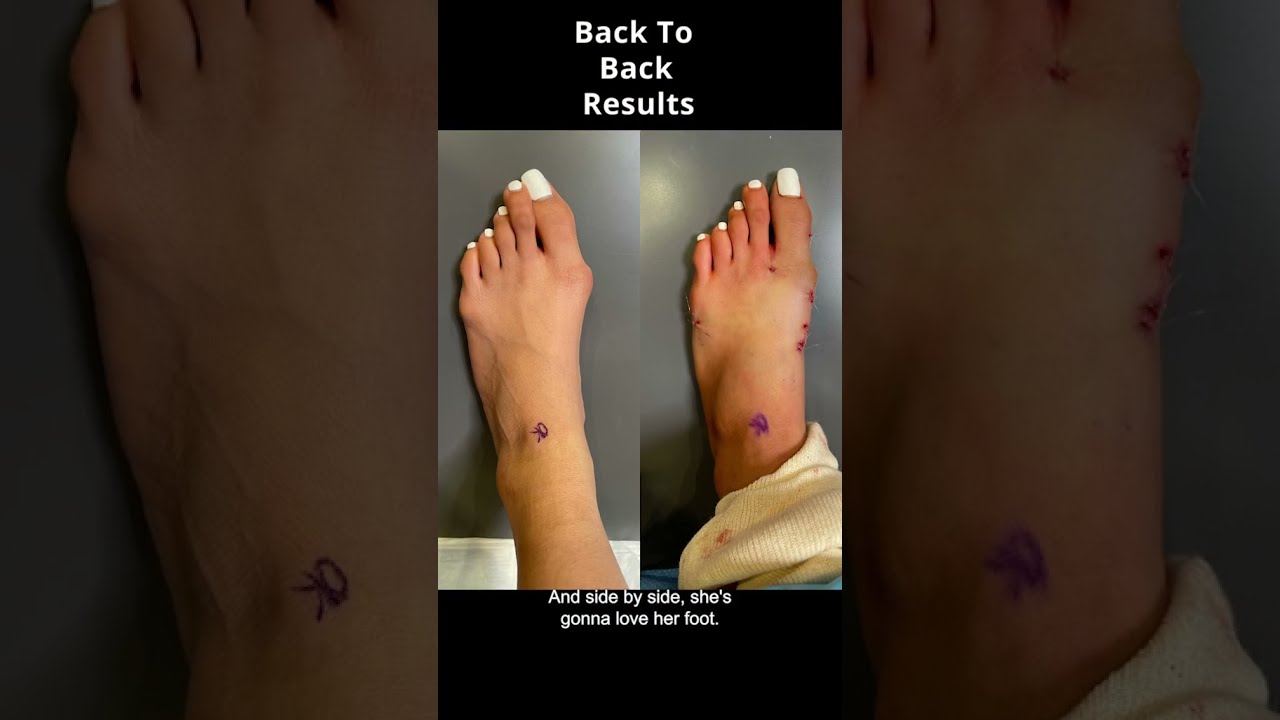 Patient undergoes 3 procedures. AMI Bunion, AMI Bunionette, & AMI Akin