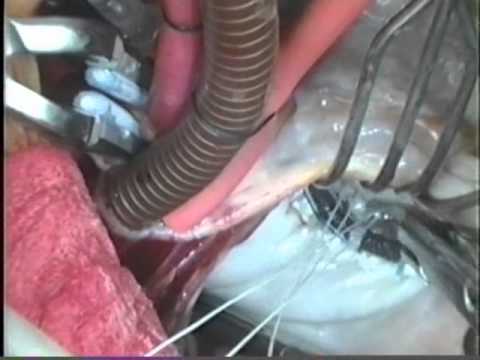 Mitral Valve Repair for Rheumatic Disease