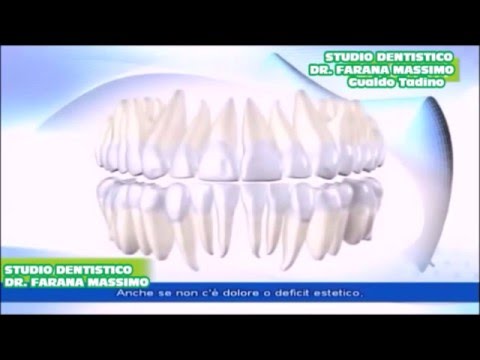 Pizzicare larteria vertebrale nel trattamento della cervice uterina 10 esercizi per osteocondrosi cervicale