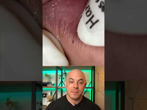 Doctor reacts to super satisfying pimple pops! #dermreacts #doctorreacts #pimplepop #cystpop