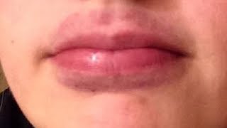 how to get rid of bruised lips tutorial