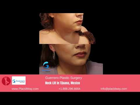 Refined Elegance: Patient Stories of Neck Lifts at Guerrero Plastic Surgery in Tijuana, Mexico