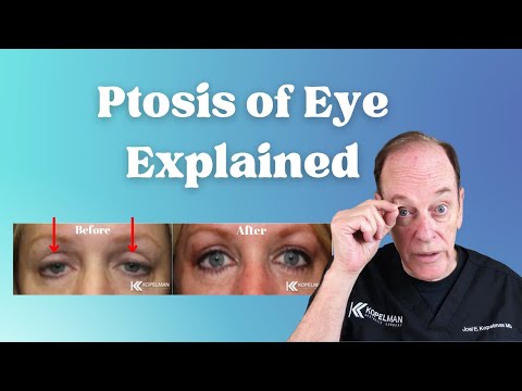 Ptosis of the Eye Explained | Eyelid Surgery for Droopy Eyelids