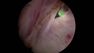 Thulium fiber laser enucleation of the prostate ThuFLEP with SOLTIVE superpulsed laser by Dr. Rijo