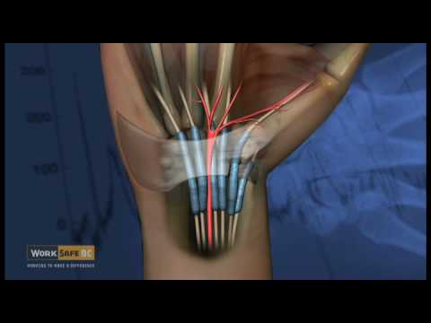 carpal artrosis tünetek kezelése