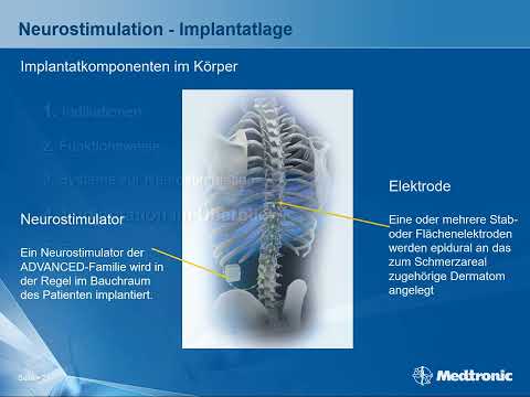 Dr. Georgios Matis - Neuromodulation - Neurostimulation bei chronischen Schmerzen