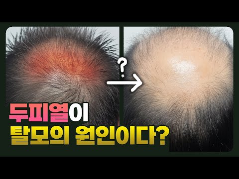 [EN][JP]탈모 원인 1위가 두피열?! (오해와 진실)