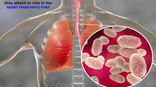 Whooping Cough: Bordetella pertussis