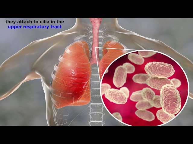 הגיית וידאו של whooping cough בשנת אנגלית