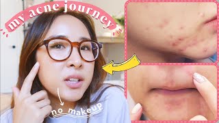 How I CLEARED my hormonal acne, NATURALLY | 7-30 day plan you can try!