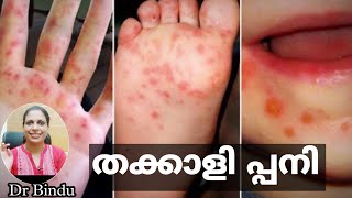 തക്കാളിപനി/Hand foot mouth disease/Baby care tips Dr Bindu