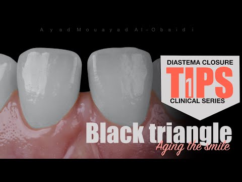 Black Triangle Diastema Closure Clinical Tips Series