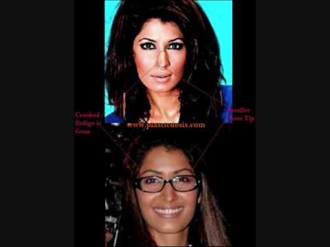 Vaneeza's Rhinoplasty( Nose Job)