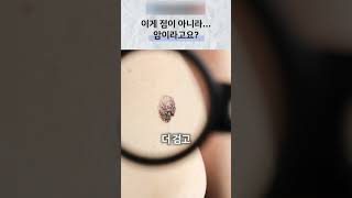 점처럼 보이는 피부암, 변화가 있다면 진단이 먼저