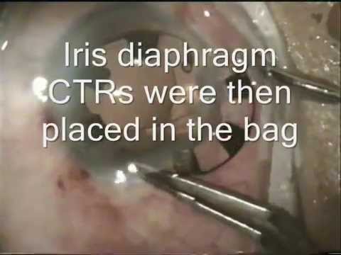 Catarct surgery with implantation of Aniridia rings