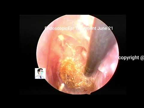 ear wax removal extraction,Simple fungi, cerumen...
