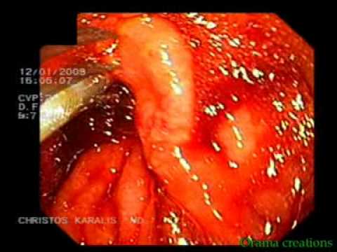 Stent Placement, Duodenal Cancer 