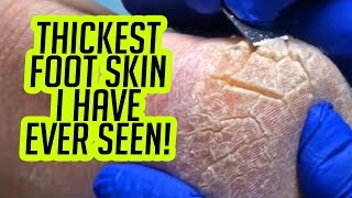 Thickest Feet I have Ever Seen!