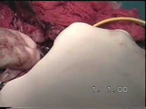 Parotid Surgery