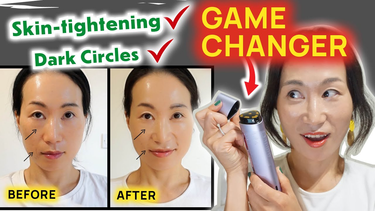 The BEST treatment for Dark Circles & Skin tightening! Amiro R3 Turbo Radiofrequency honest review❗