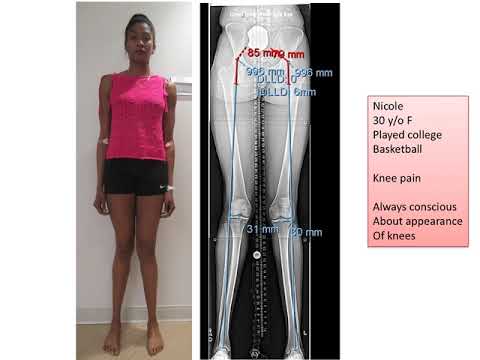 Image - Knock Knee Treatment