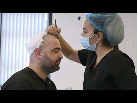 Hanni Hanna @HanniHanna  heeft gekozen voor zijn eigen haartransplantatie voor | Hair Time İstanbul