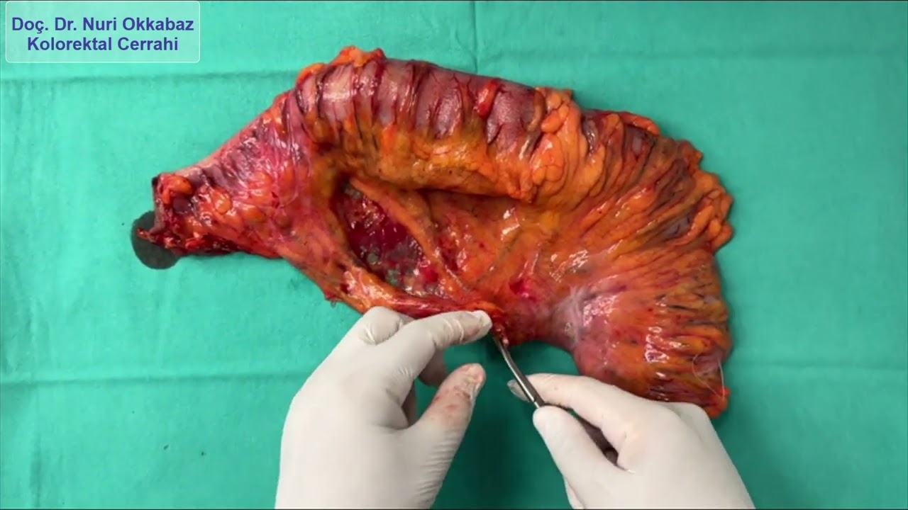 Specimen Evaluation in Laparoscopic Surgery for Obstructive Colon Cancer