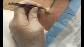 What a Beauty!  Snowy White Sebaceous Cyst Begs to be Seen &amp; Loved!