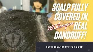 2MuchHair Full Dandruff Treatment w/ Dry Scratches an Shampoo asmr