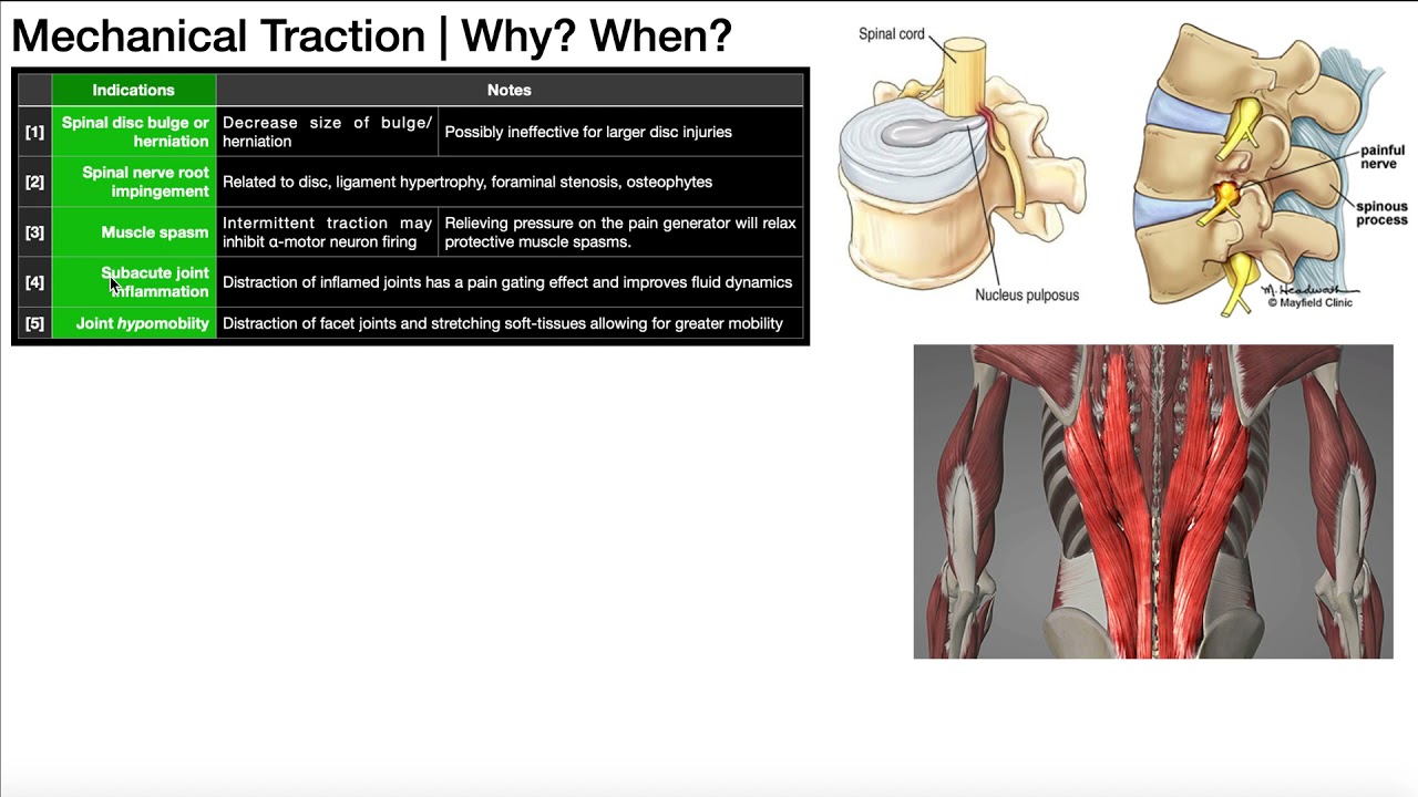 Mechanical Traction Part 1 | Theory, Indications & Contraindications - YouTube