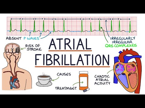 Understanding Atrial Fibrillation