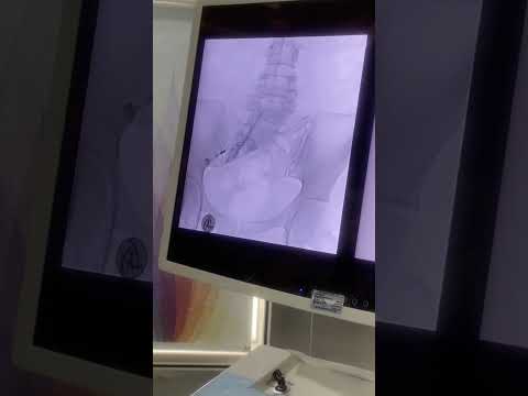 Sciatica treatment and MIPSI care explained by JPRC Neuro Spine Centre