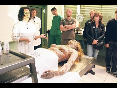 Escherichia coli in Prostata- secret Was bedeutet ehopriznaki chronische Prostatitis