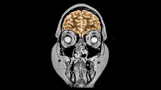 A Mom Drank 3 Gallons Water In 2 Hours. This is What Happened to Her Brain.