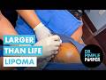 Larger Than Life Lipoma That Dr Pimple Popper Couldn T Believe