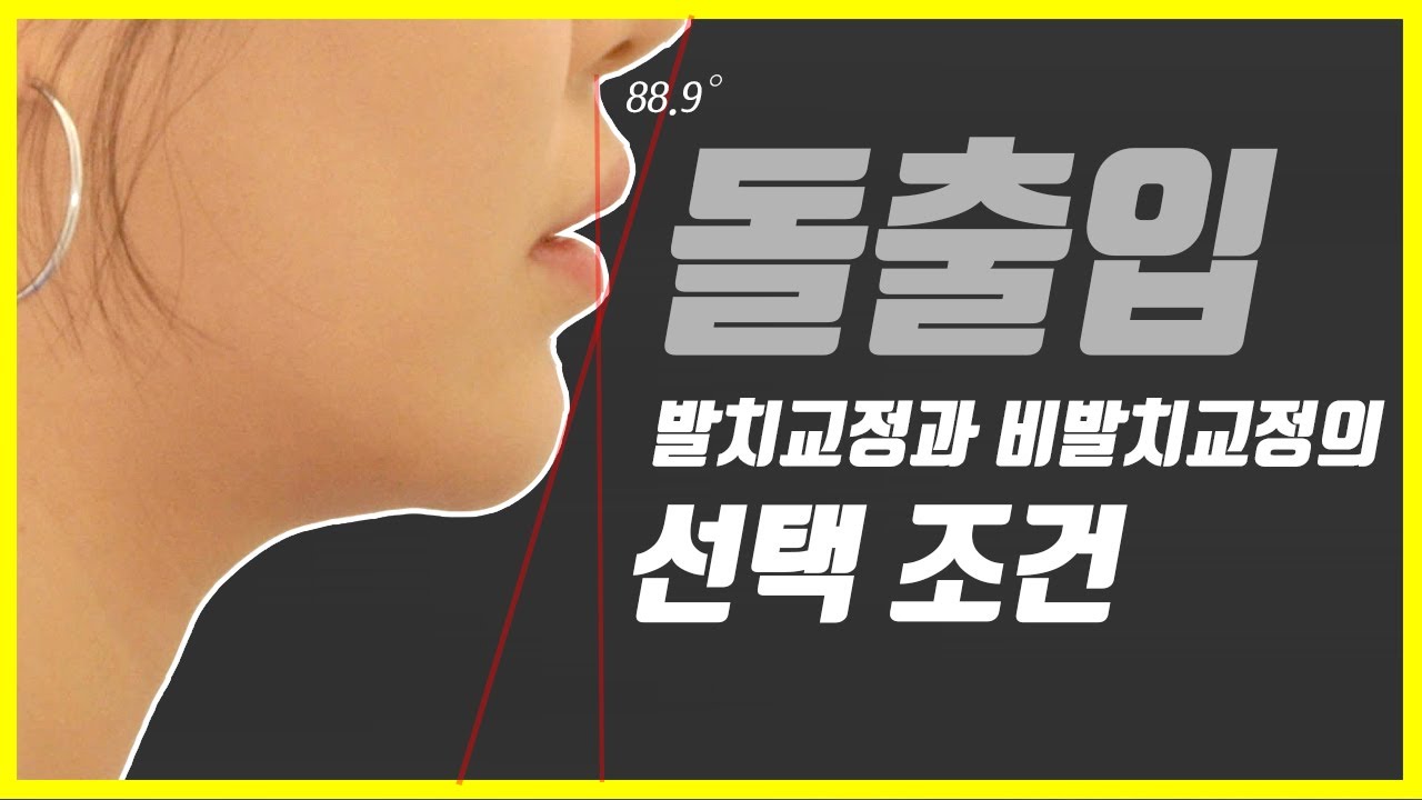 돌출입 교정의 진실 입툭튀2부: 돌출입교정 발치교정과 비발치교정의 기준,부작용,거미스마일,옥니,팔자주름