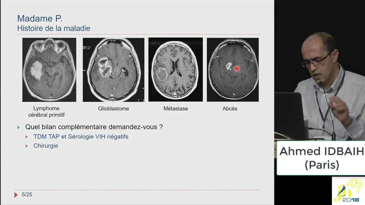 Watch video J2N 2018 - Session - Neuro-oncologie J2N 2018 - Session - Neuro-oncologie