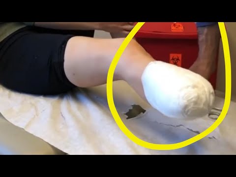 The moment I saw my amputated stump for the FIRST time #Shorts