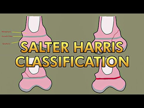 Salter Harris Classification for Pediatric Growth Plate Fractures