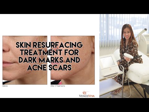 Venus Viva Treatment Acne Scars & Dark Spots after Skinlueur Celebrity Facial