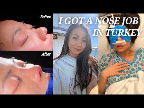 NOSE JOB (RHINOPLASTY) IN TURKEY VLOG | Dr.Mehmet Can Ubur | Full Experience + Cast Off Reveal