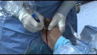 METATARSALGIA + DEDO EN MARTILLO