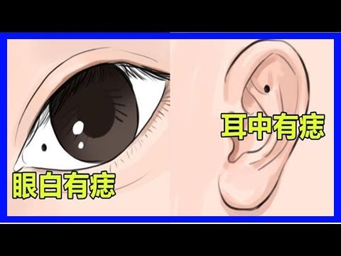 眼內有痣
