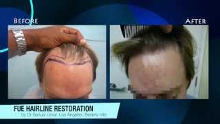 Amazing Hairline Transformation -- FUE Results For Belvedere, CA Patients