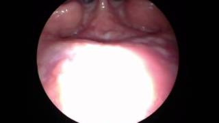 Download lagu endoscope-i PNS examination mp3 Download lagu endoscope-i PNS examination mp3