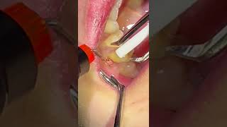 DentaLaze Removing a Pregnancy Tumor