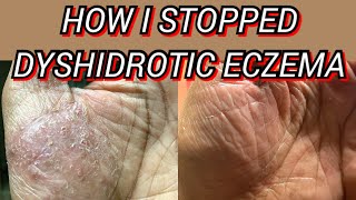 HOW I STOPPED DYSHIDROTIC ECZEMA ON MY PALMS FINGERS AND HANDS